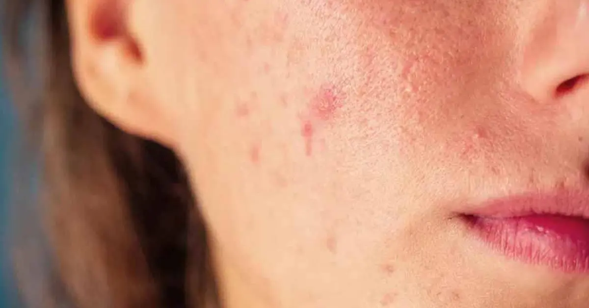 غذاهای مضر برای پوست صورت