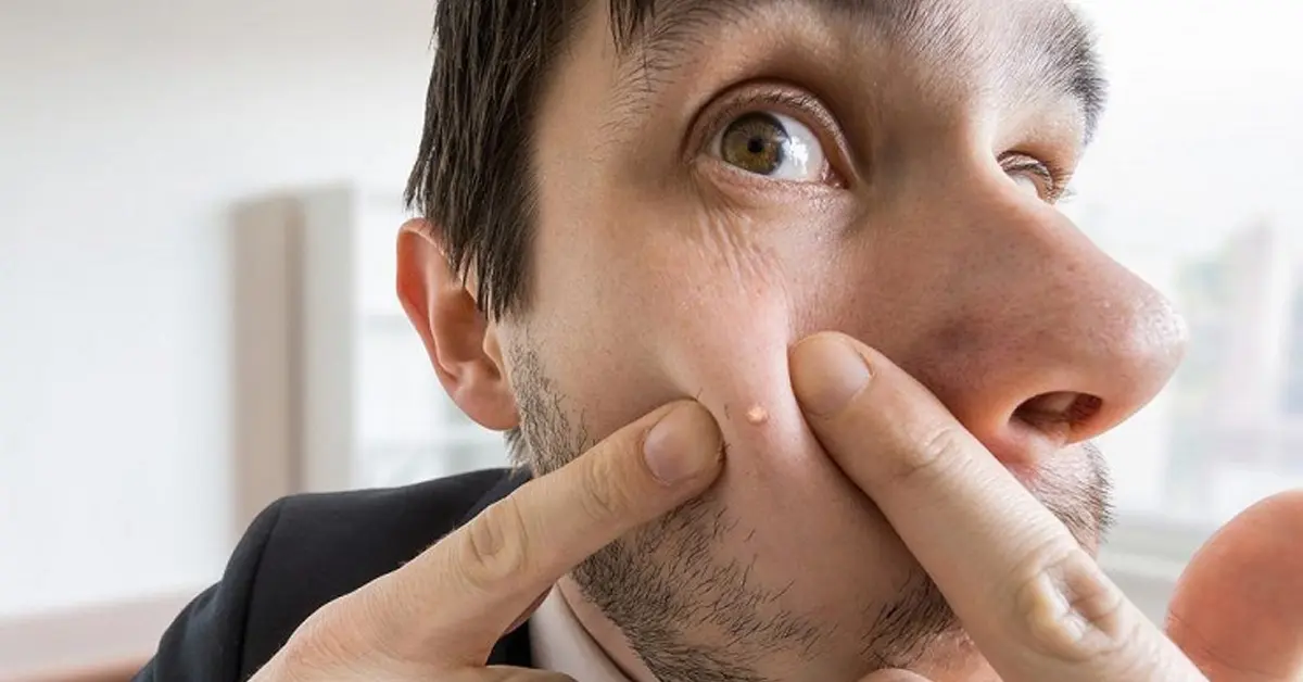 درمان جوش و آکنه صورت چیست؟