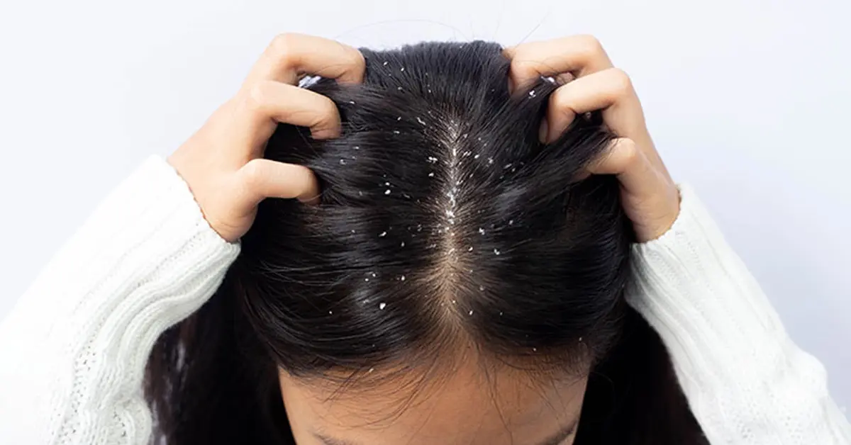 درمان سریع شوره سر