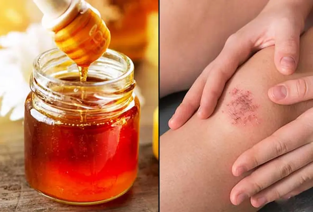 بهبود زخم‌ها یکی از خواص درمانی عسل