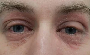 دلایل و درمان خشکی پلک