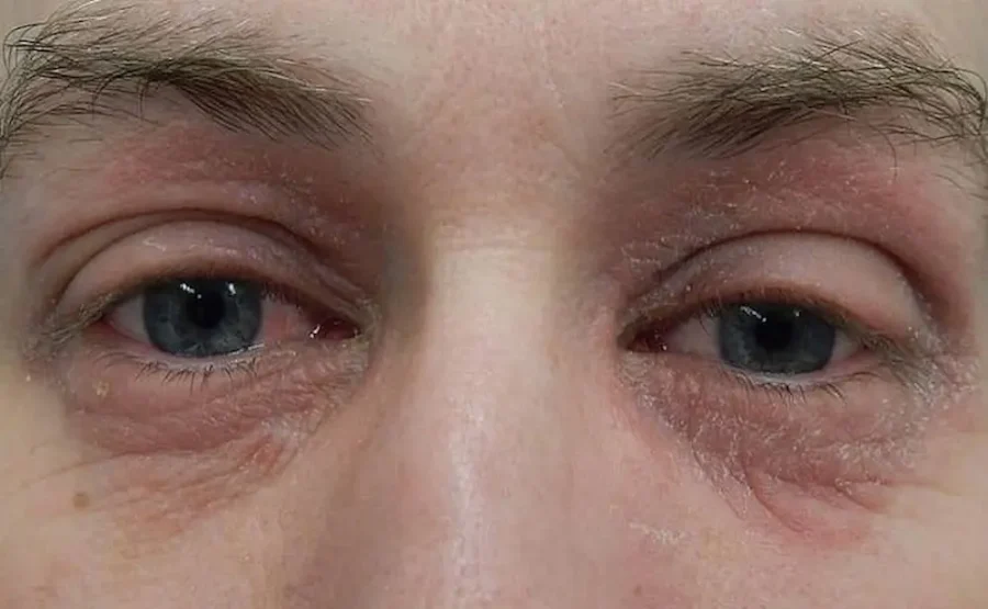 دلایل و درمان خشکی پلک