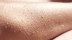 علل و روش های تشخیص پوست مرغی بدن