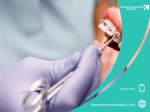 کدام دندان‌ها باید ارتودنسی شوند؟