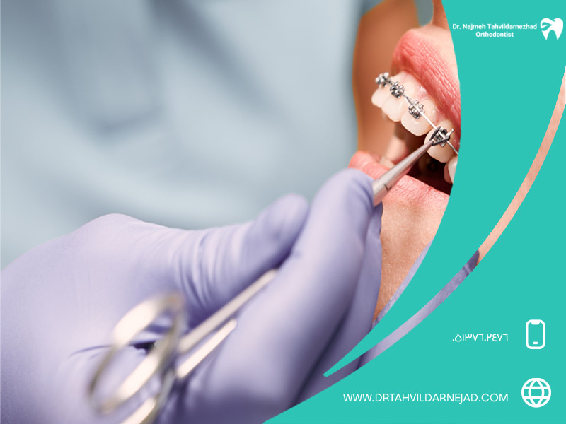 کدام دندان‌ها باید ارتودنسی شوند؟