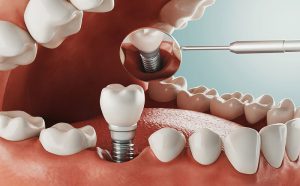 ایمپلنت فوری در تهران