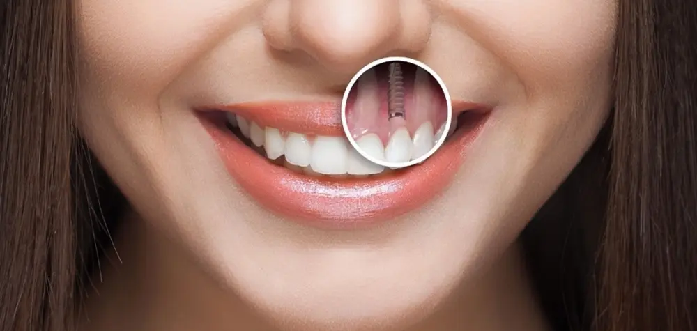 ایمپلنت دندان مشابه با دندان طبیعی