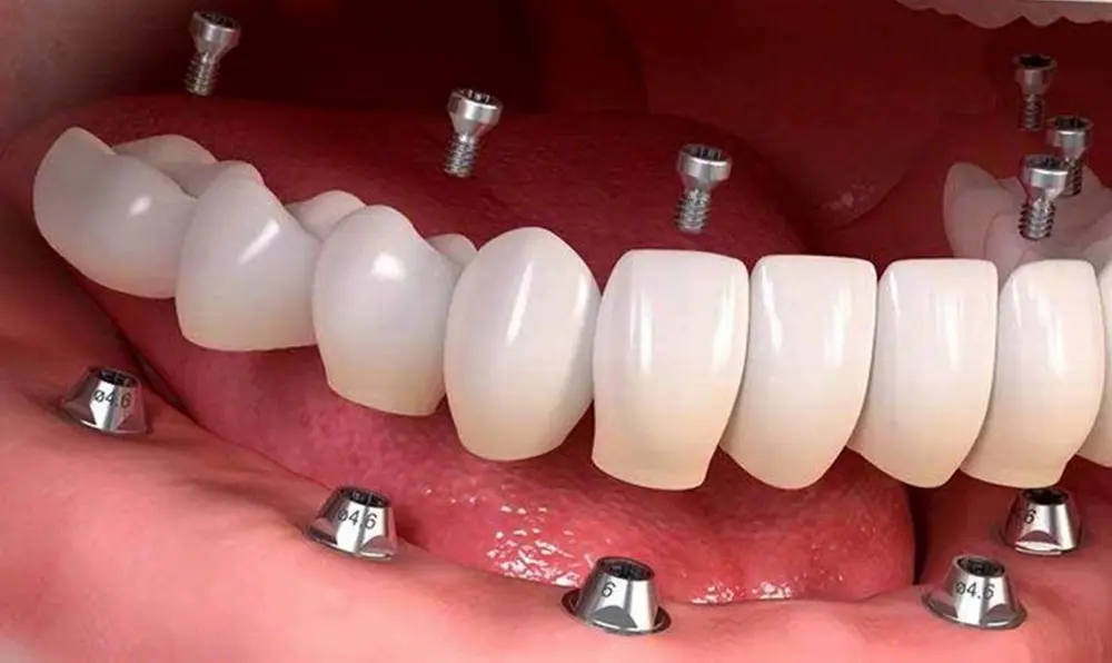 ایمپلنت با بیش از 20 سال دوام