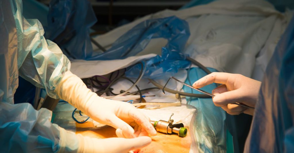 عوامل مؤثر بر قیمت اسلیو معده